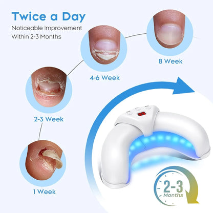 FungalEase Pro Antifungal Laser