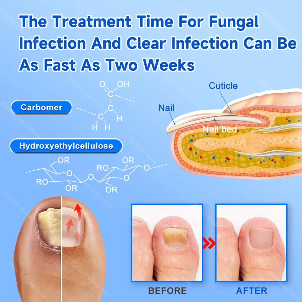 FungalEase Pro Antifungal Laser